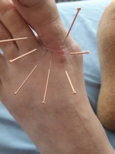 Ligament Acupuncture
